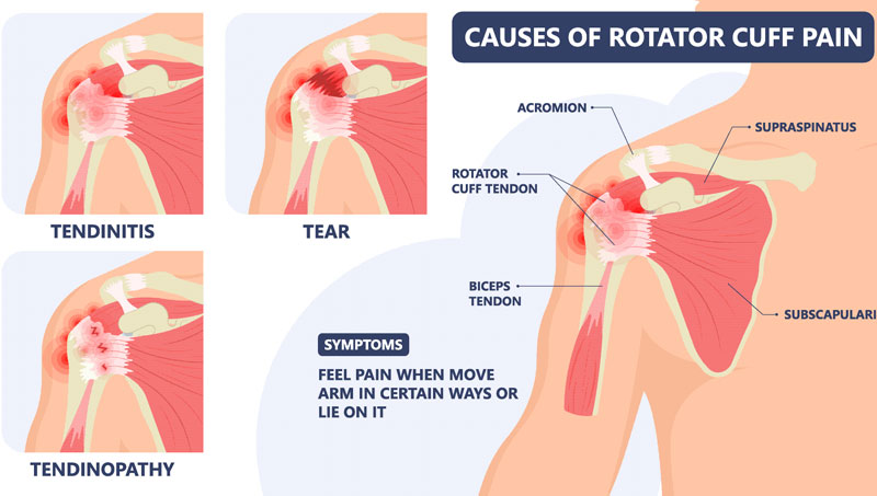 Rotator Cuff Injuries - Move Osteopathy