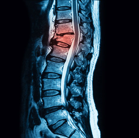 Vertebral Compression Fractures (VCF) - Treatment by Spine